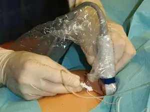 Peripheral Nerve Block