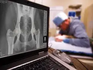 Computed Radiography Digital X-Ray