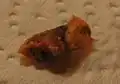 Diesen Pfropfen hat ein Arzt mit einer feinen Zange herausgeholt.