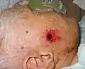 Ein roter Fleck auf der Wange eines alten Mannes. Das ist eine Form von Hautkrebs.