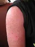 Wenn ein starker Sonnenbrand abheilt, schuppt die zerstörte Haut ab.