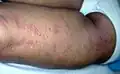 Dasselbe Virus kann bei älteren Menschen die schmerzhafte Krankheit Herpes Zoster auslösen. Man nennt sie auch Gürtelrose.