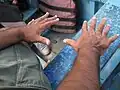 Sehr selten: Ein Mensch mit je sechs Fingern an jeder Hand.