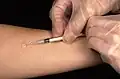Ein Test zum Erkennen von Tuberkulose