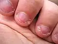 So sehen abgekaute Fingernägel aus.
