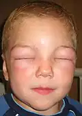 Dieses Kind hat das Quincke-Ödem, bei dem die Augen zuschwellen.