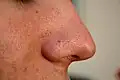 Nase mit Mitessern