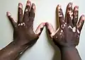 Vitiligo ist eine Besonderheit der Haut, bei der einige Stellen weiß werden.