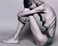 Anorexia3.jpg