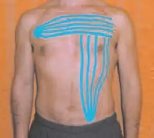 Kinesiotape2.jpg