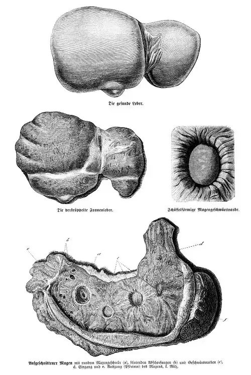 Die Gartenlaube (1872) b 773.jpg Die gesunde Leber. Die verkrüppelte Frauenleber. Schüsselförmige Magengeschwürsnarbe. Aufgeschnittener Magen.