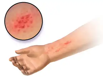 Allergic contact dermatitis