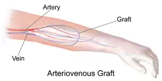 Arteriovenous graft for hemodialysis.