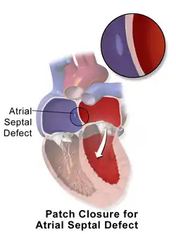 Correction of an atrial septal defect using a patch.