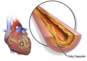 Atherosclerotic plaque of a coronary artery.