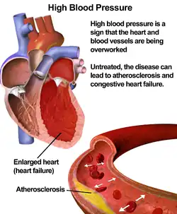 Hypertension.