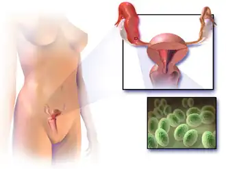 Pelvic inflammatory disease.